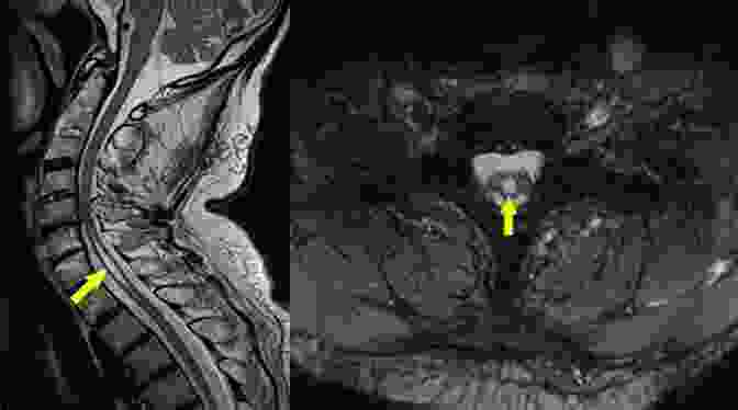 Magnetic Resonance Imaging (MRI) Scan Depicting A Syrinx, A Fluid Filled Cavity Within The Spinal Cord Characteristic Of Syringomyelia Syringomyelia: A Disorder Of CSF Circulation