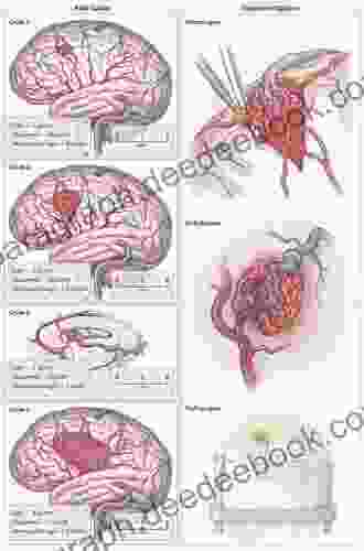 Cranial Arteriovenous Malformations (AVMs) And Cranial Dural Arteriovenous Fistulas (DAVFs) An Issue Of Neurosurgery Clinics (The Clinics: Surgery 23)