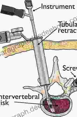 Instrumentation For Minimally Invasive Spine Surgery